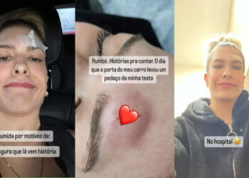 Dançarina Lore Improta sofre acidente doméstico e é hospitalizada após bater a testa na quina da porta do carro