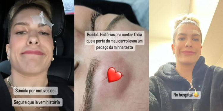 Dançarina Lore Improta sofre acidente doméstico e é hospitalizada após bater a testa na quina da porta do carro